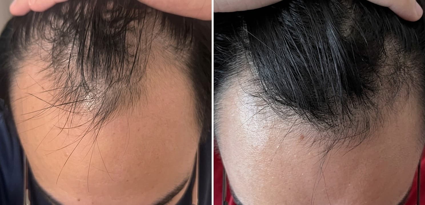 Patient result — 11 months of treatment