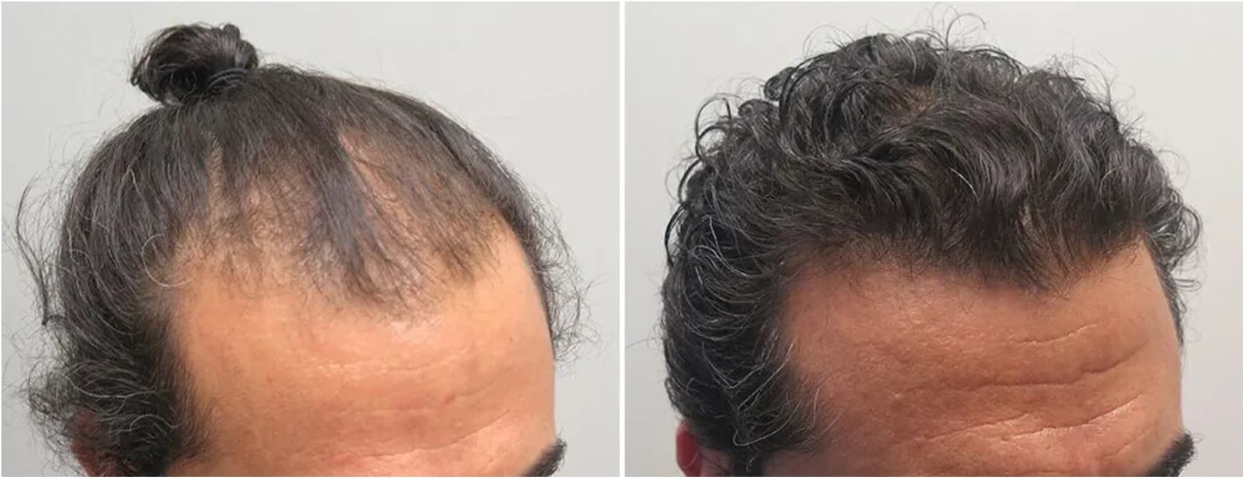 Patient result — 6 months of treatment