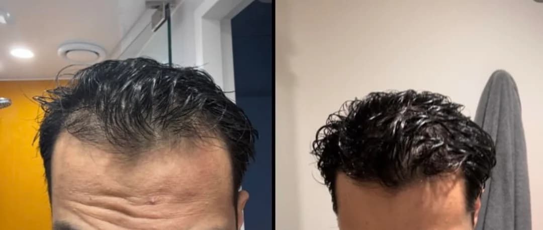 Patient result — 8 months of treatment
